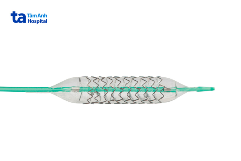 Stent kim loại và ống thông được đặt trong lòng bóng