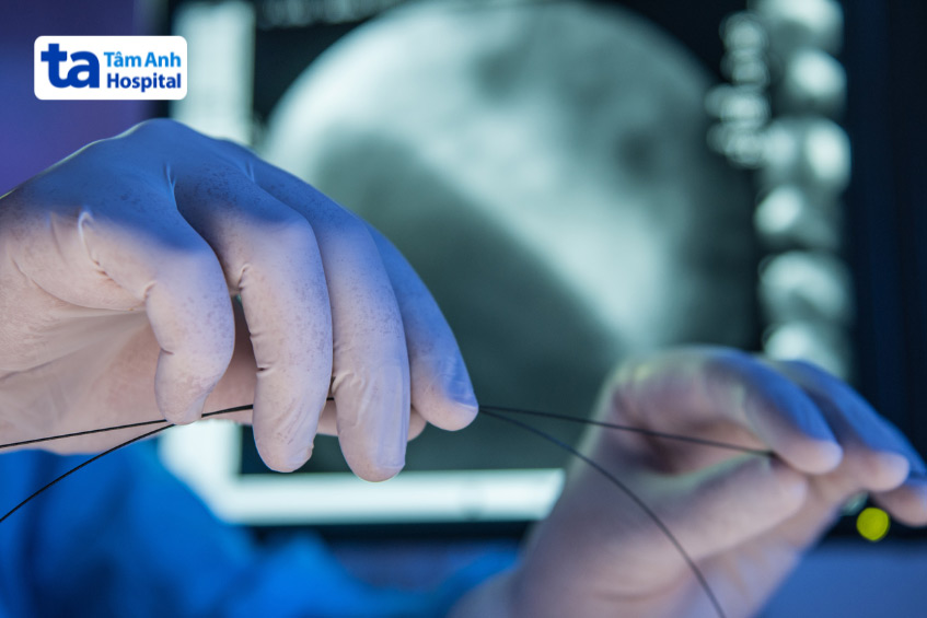 Stent là một ống nhỏ giúp máu trong động mạch được lưu thông dễ dàng