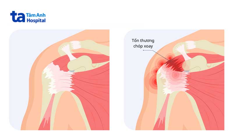 Tác dụng phụ khi tiêm gân cơ trên gai