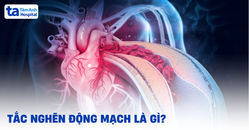Tắc nghẽn động mạch là gì?