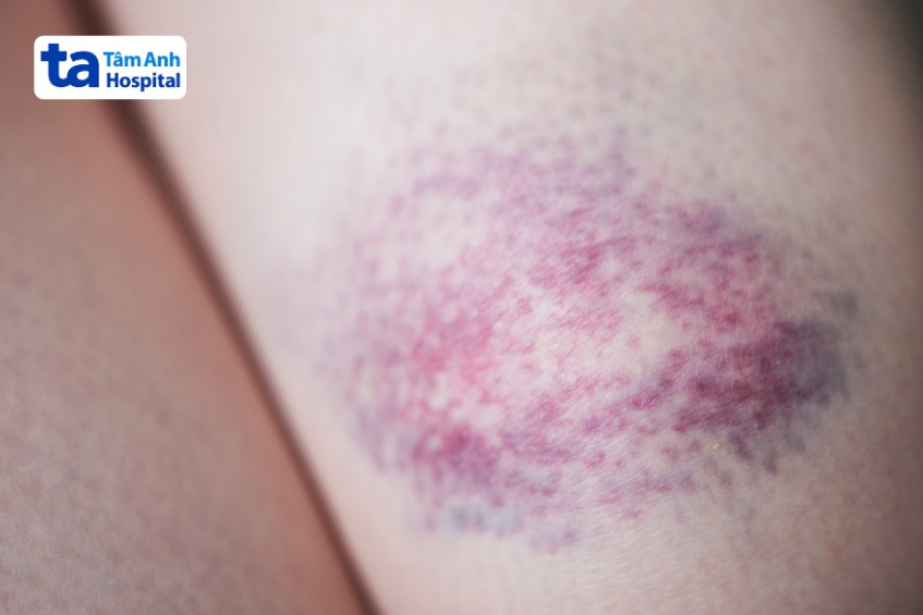 tăng tiểu cầu bị bầm tím