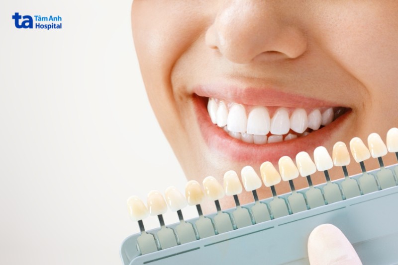 Tẩy trắng răng là gì?