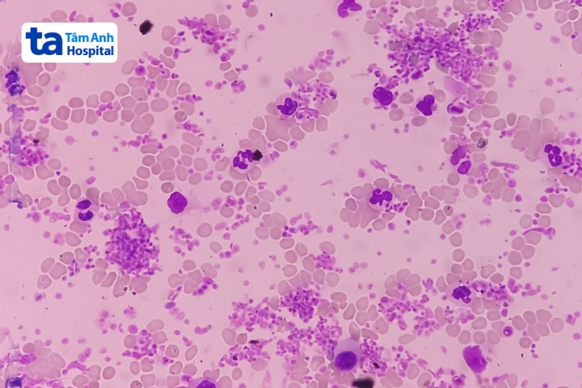 tế bào tiểu cầu tăng