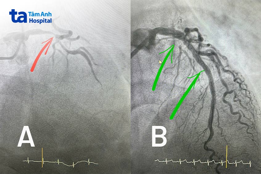 Thân chung mạch vành trái tắc gần hết (hình A) và sau khi được can thiệp tái thông (hình B)
