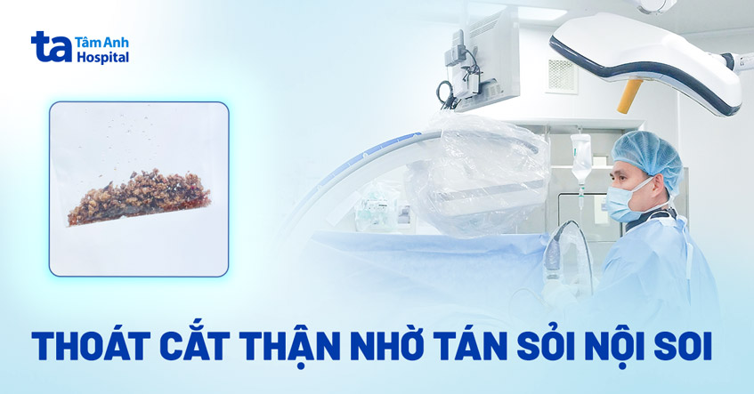 Thoát cắt thận nhờ tán sỏi nội soi