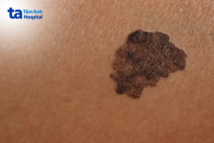 tổn thương của ung thư hắc tố da