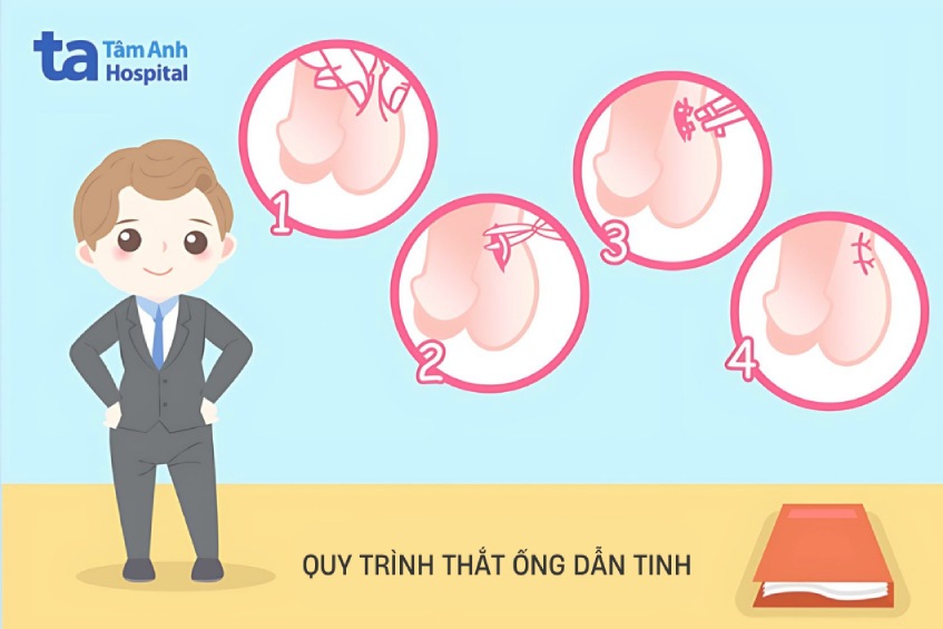 tổng quan về thắt ống dẫn tinh