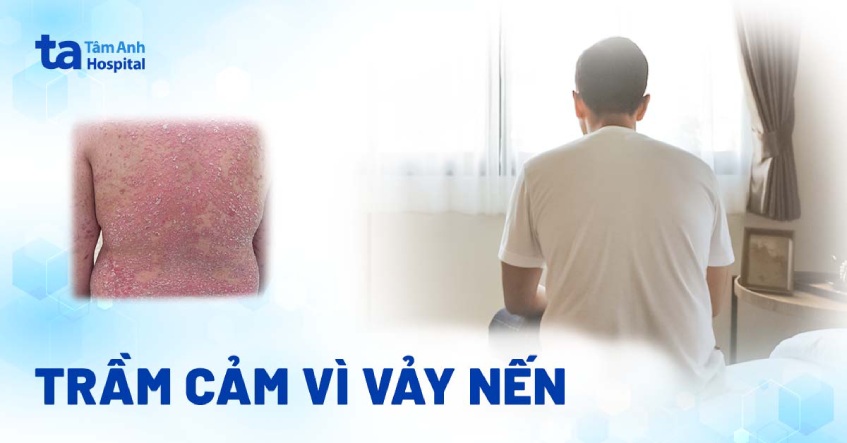 Trầm cảm vì vảy nến