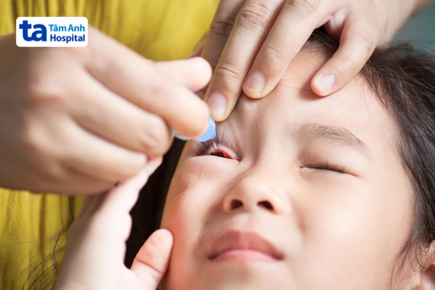 Trẻ bị viêm kết mạc cần được chăm sóc, điều trị đúng cách