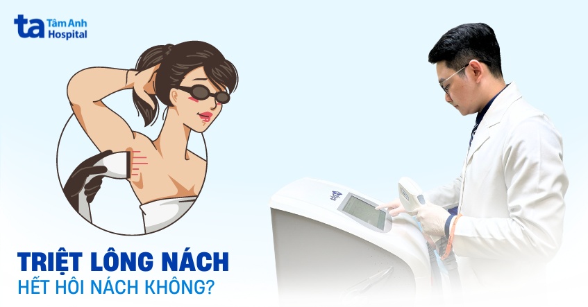 triệt lông nách có hết hôi nách không