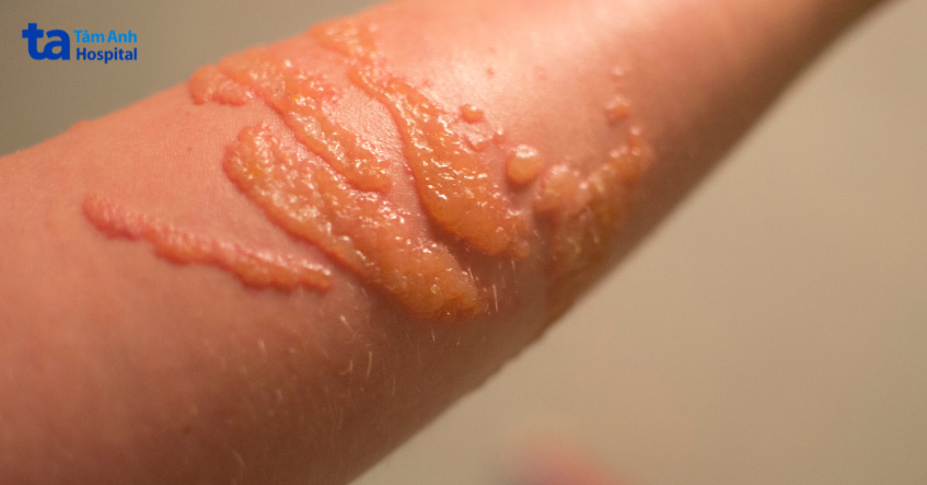 triệu chứng Pemphigus trên da khi mới phát bệnh