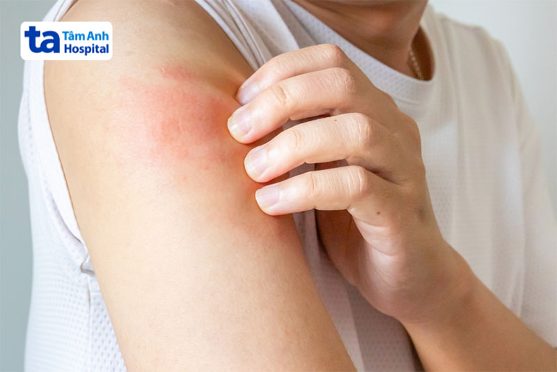 triệu chứng của viêm cơ tự miễn