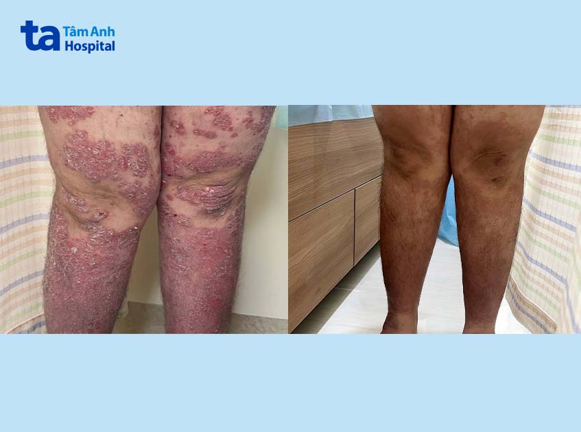 trước và sau khi điều trị vảy nến