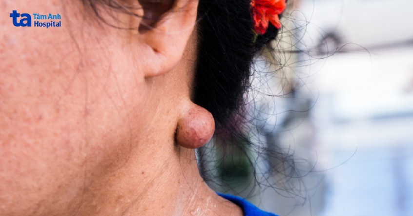 u bã đậu ở cổ là gì