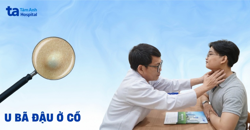 U bã đậu ở cổ: Nguyên nhân, triệu chứng, cách điều trị, phòng ngừa
