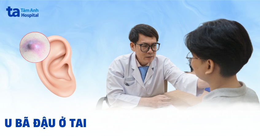 U bã đậu ở tai: Nguyên nhân, hình ảnh, chẩn đoán, cách điều trị