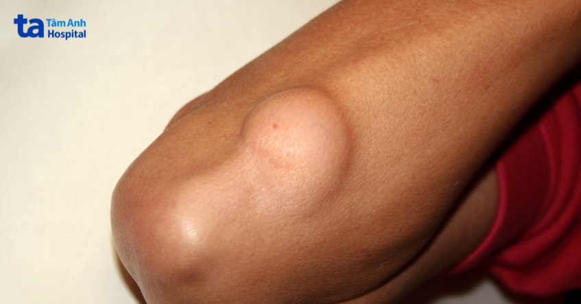 u mỡ dưới da là gì