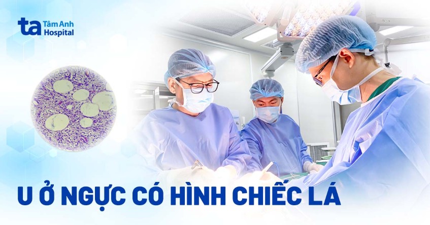 U ở ngực có hình chiếc lá