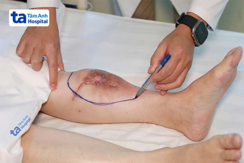 Chuyển vạt đòi hỏi phải được thực hiện cẩn thận ngay từ bước chuẩn bị