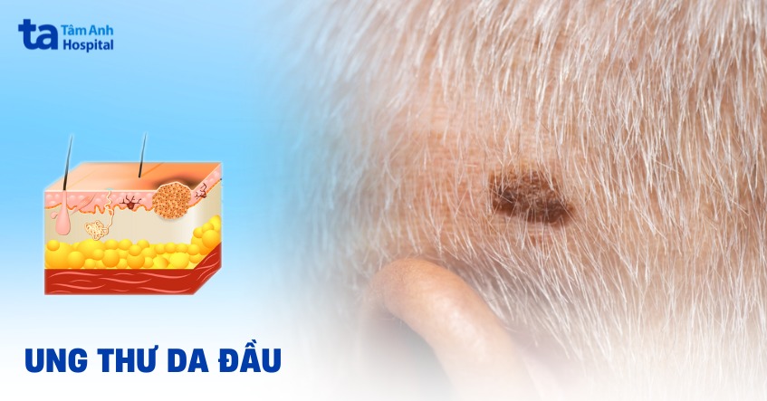 ung thư da đầu