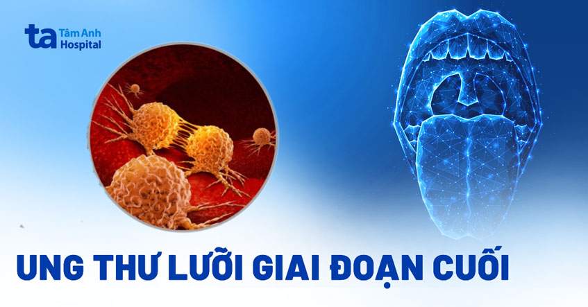 Ung thư lưỡi giai đoạn cuối: Nguyên nhân, dấu hiệu và cách điều trị