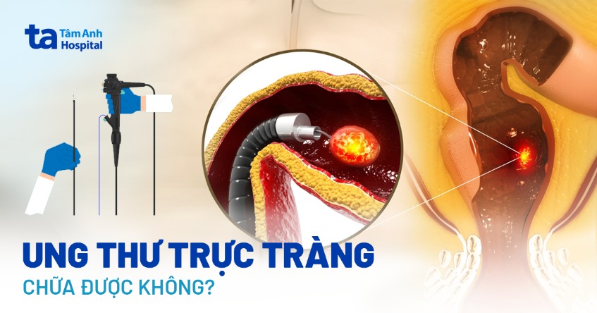 Bệnh ung thư trực tràng có chữa được không? Yếu tố nào ảnh hưởng?