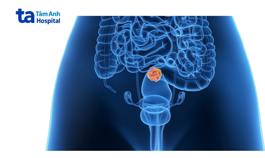 ung thư trực tràng có khả năng chữa khỏi nếu phát hiện sớm