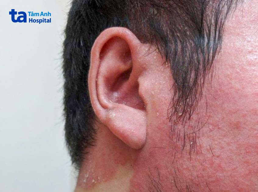 vảy nến ở tai bệnh nhân