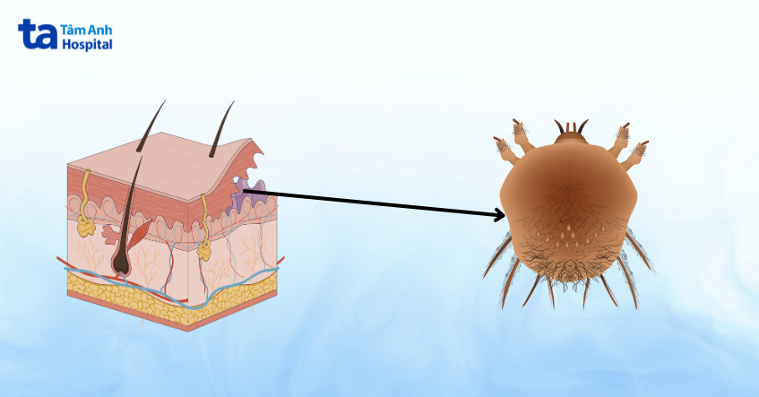 ve ghẻ thường ký sinh ở lớp sừng của da