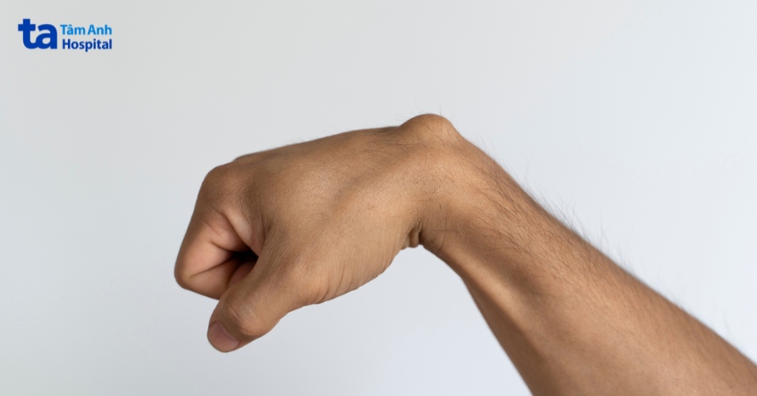 vị trí u mỡ dưới da thường gặp