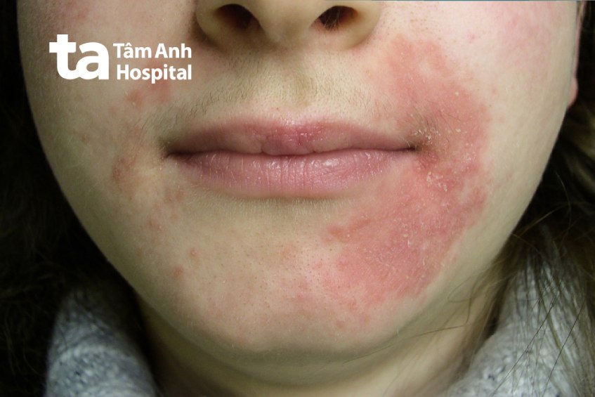 viêm da quanh miệng