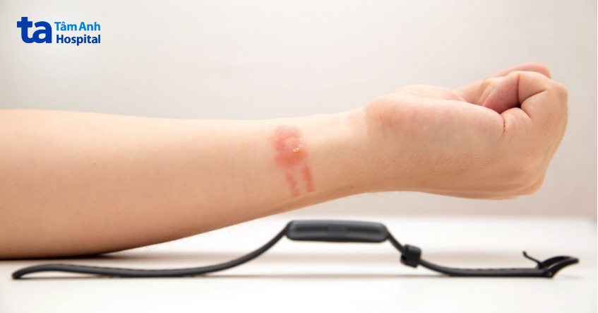 viêm da tiếp xúc có lan ra xung quanh không