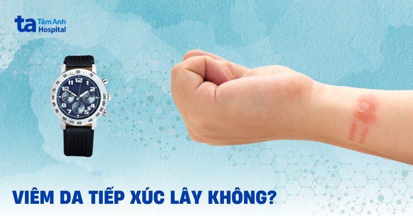 Viêm da tiếp xúc có lây không? Có lan ra xung quanh không?