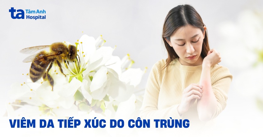 Viêm da tiếp xúc côn trùng: Nguyên nhân, triệu chứng và điều trị