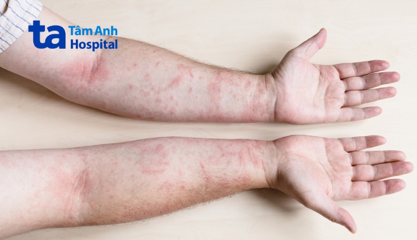 viêm da tiếp xúc