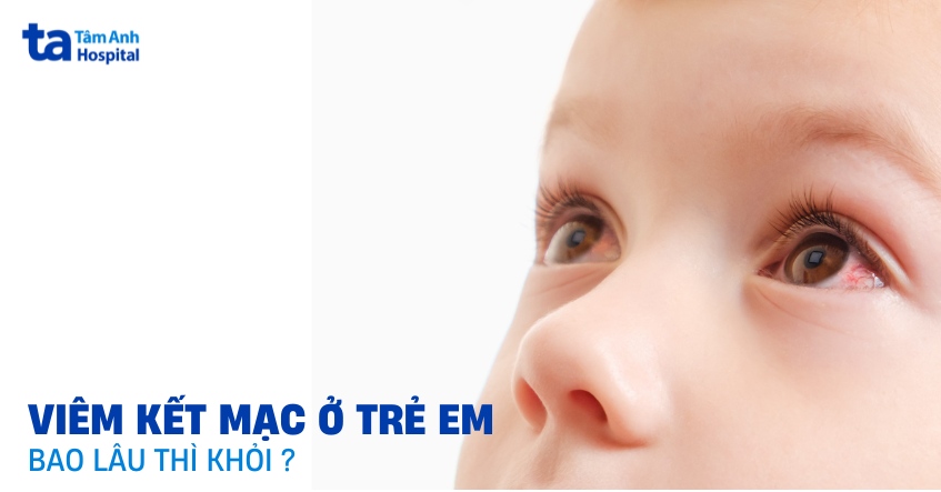 Viêm kết mạc ở trẻ em bao lâu thì khỏi? Thời gian có lâu không?