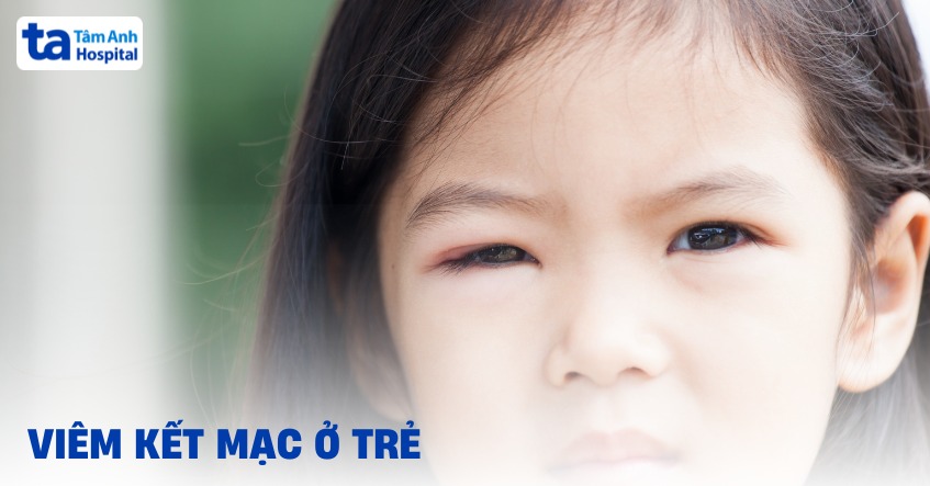 Viêm kết mạc ở trẻ em: Nguyên nhân, triệu chứng và cách chẩn đoán
