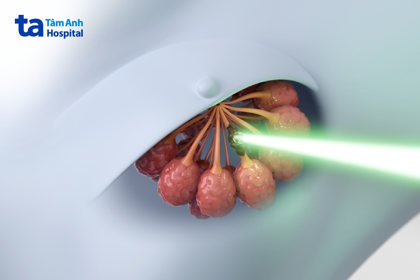 xạ trị ung thư biểu mô ống tại chỗ