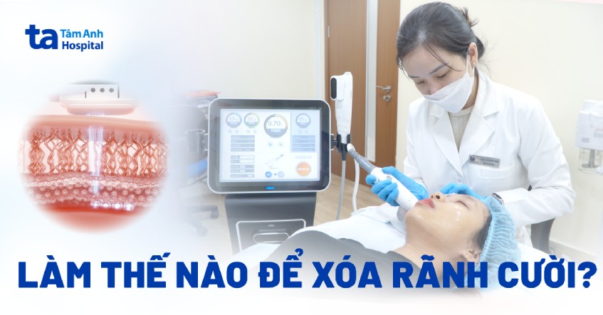 7 cách xóa rãnh cười hiệu quả giúp giảm nếp nhăn ngay tại nhà