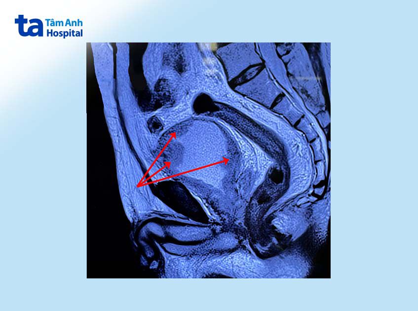 ảnh chụp mri bàng quang bệnh nhân