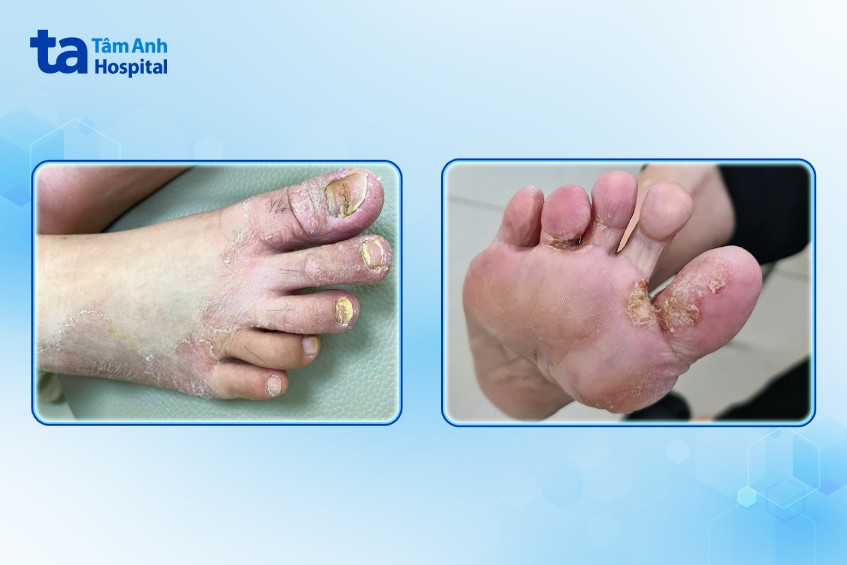 bàn chân bị nấm móng nấm kẽ chân