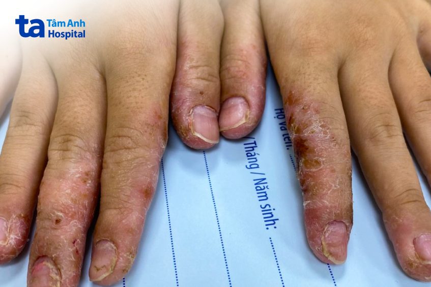 bàn tay một người bệnh