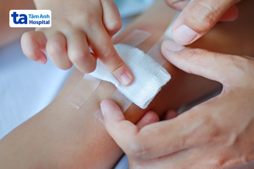 Băng vết bỏng đúng cách để ngăn ngừa nhiễm trùng
