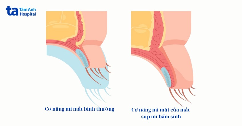 bất thường cơ mí mắt gây sụp mí bẩm sinh