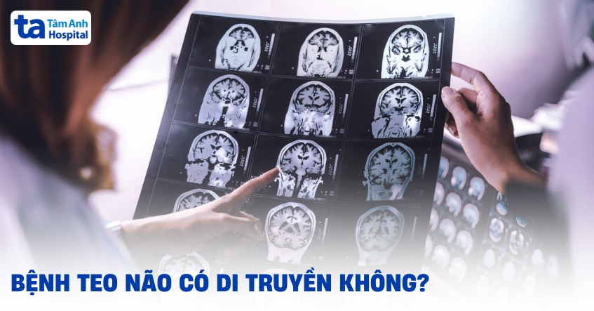 Bệnh teo não có di truyền không? Chuyên gia giải đáp