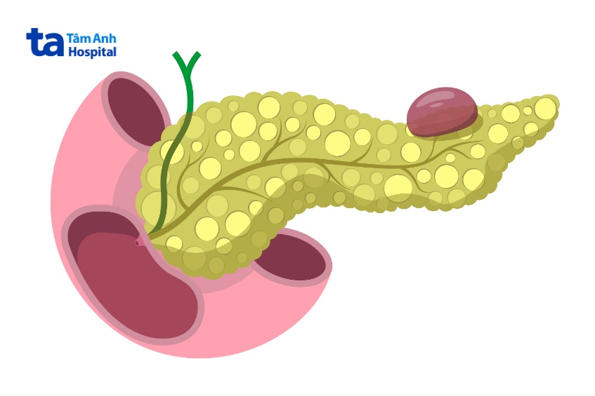 bị nang giả tụy