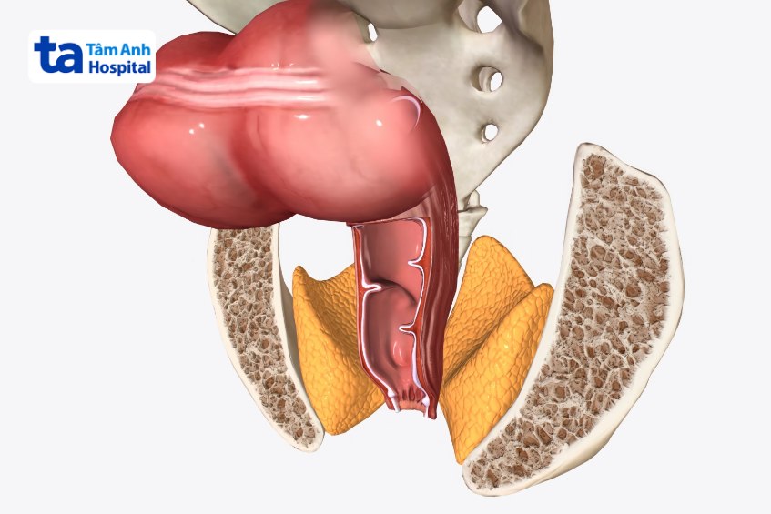 bị rò hậu môn áp xe hóa