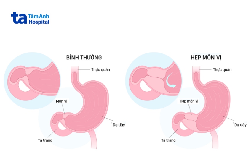Biến chứng hẹp môn vị do viêm loét dạ dày tá tràng