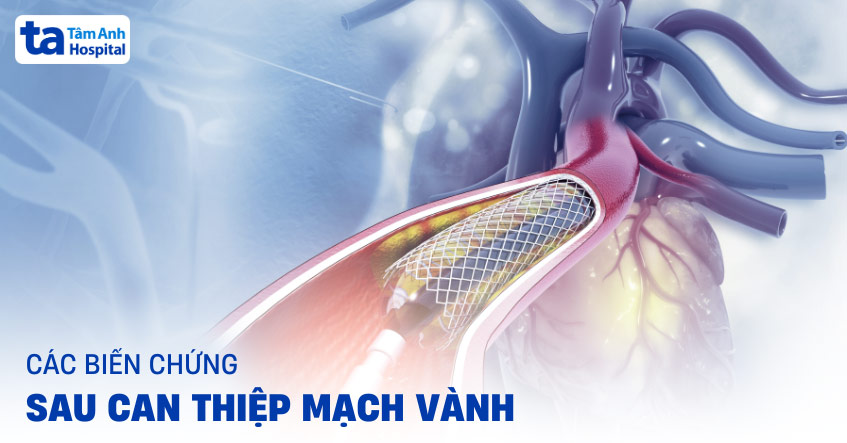 10 biến chứng sau can thiệp mạch vành nguy hiểm có thể gặp