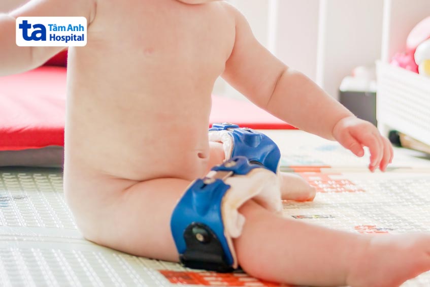 bó bột và đep nẹp